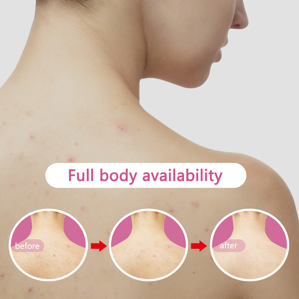 Plasma Skin Resurfacing Beauty Device