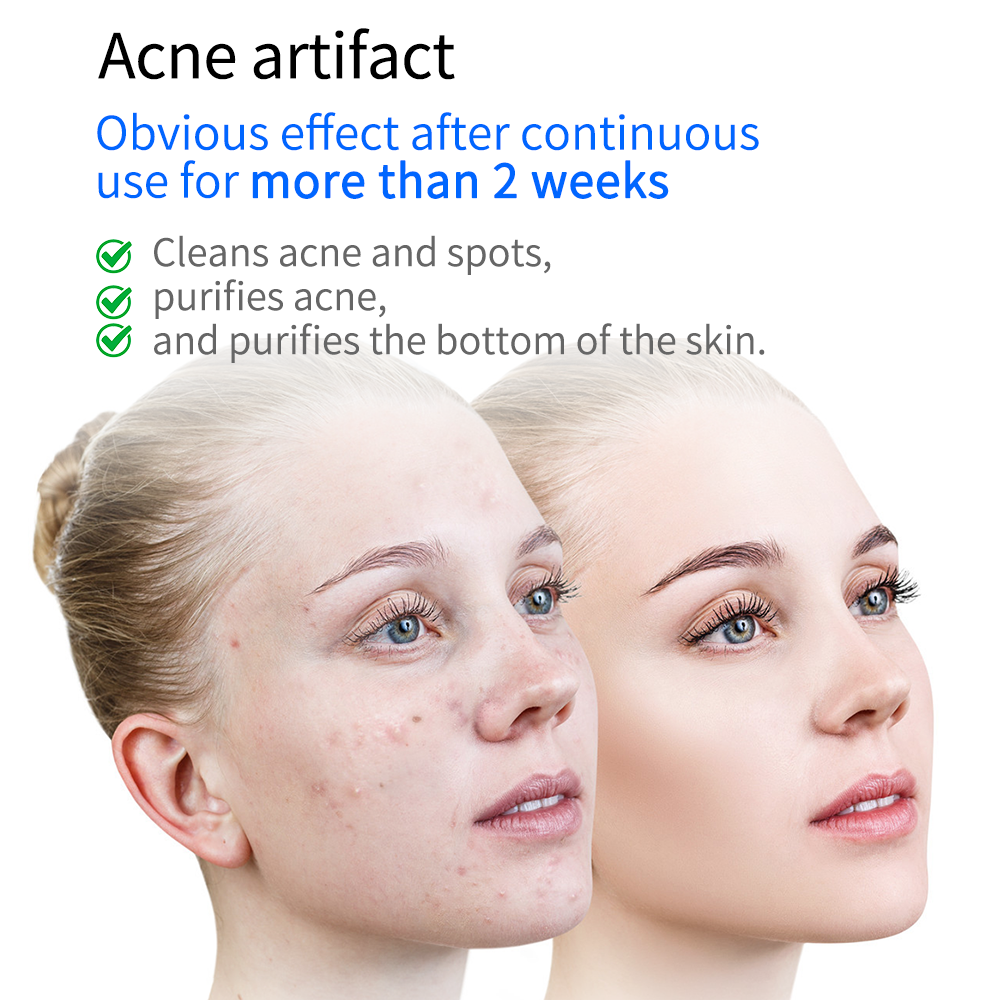 Plasma Skin Resurfacing Beauty Device