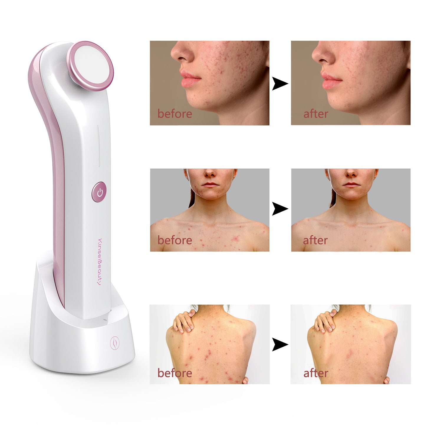 Plasma Skin Resurfacing Beauty Device